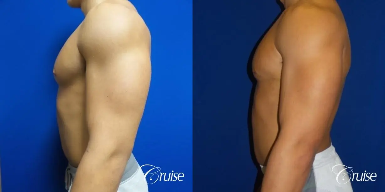 bodybuilder with gynecomastia - Before and After 3