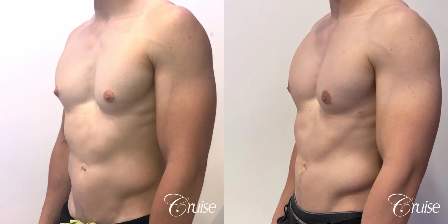 gynecomastia with puffy nipples - Before and After 3