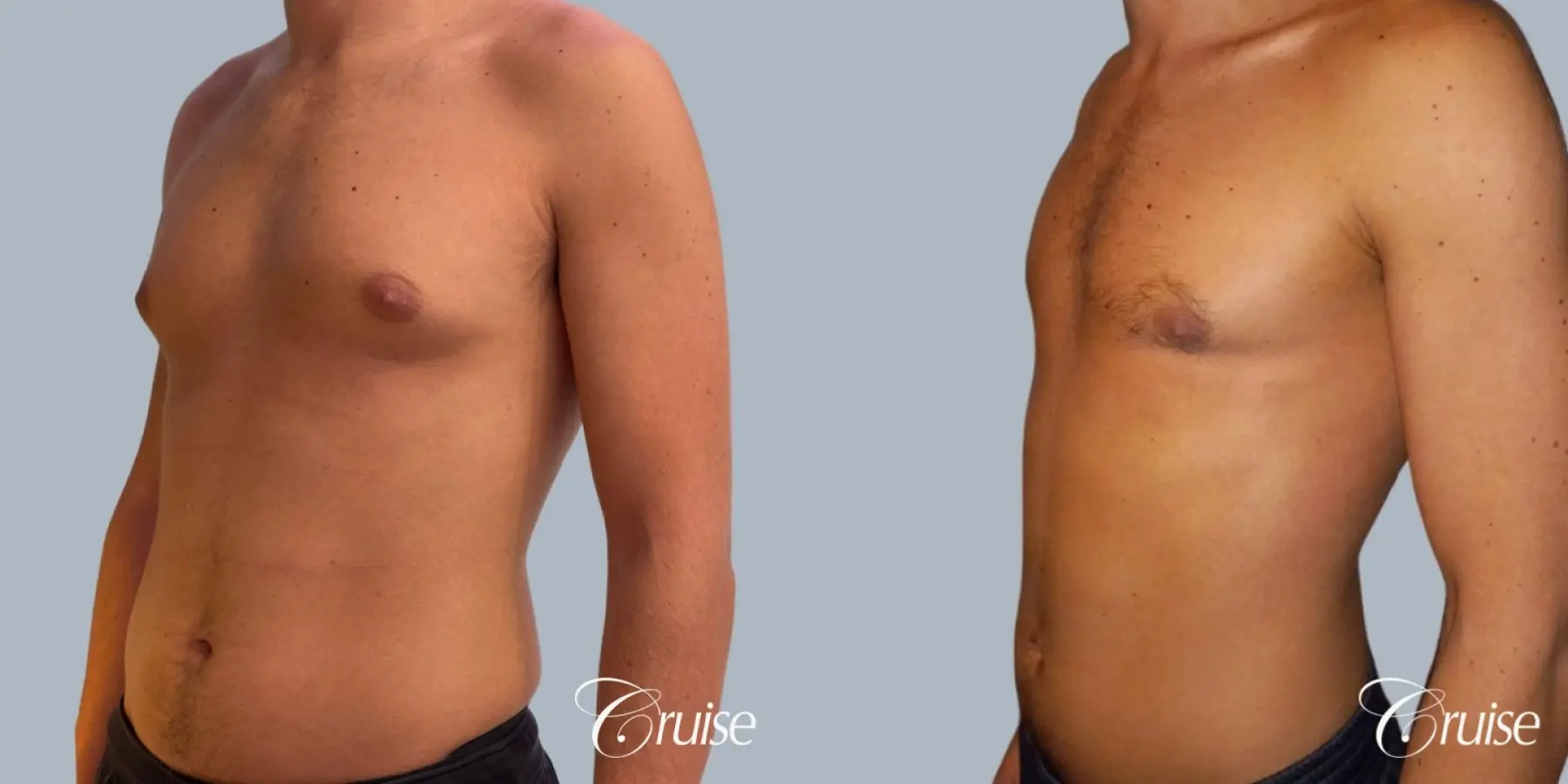 Gynecomastia: Patient 150 - Before and After 3