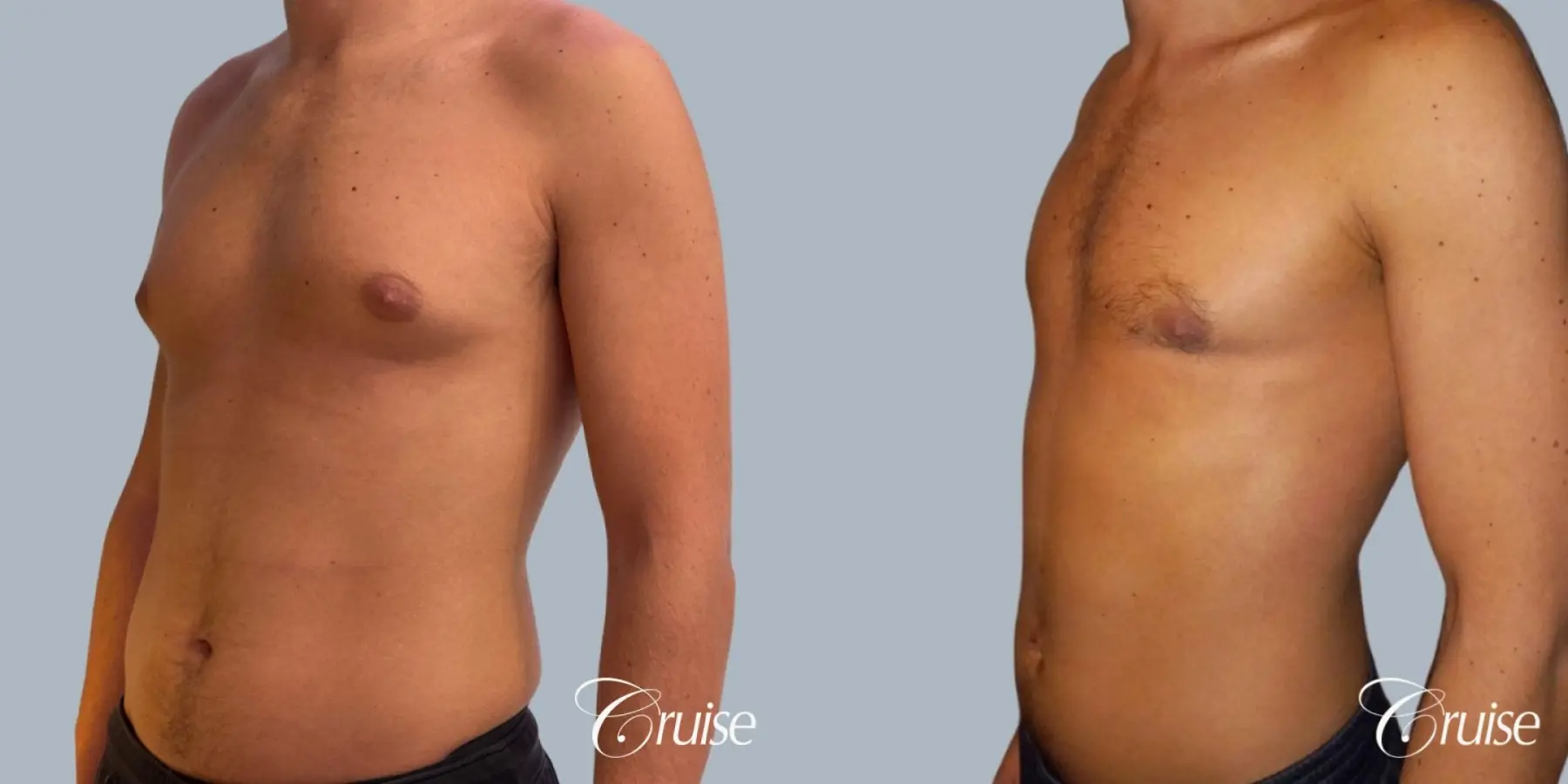 Gynecomastia: Patient 154 - Before and After 3