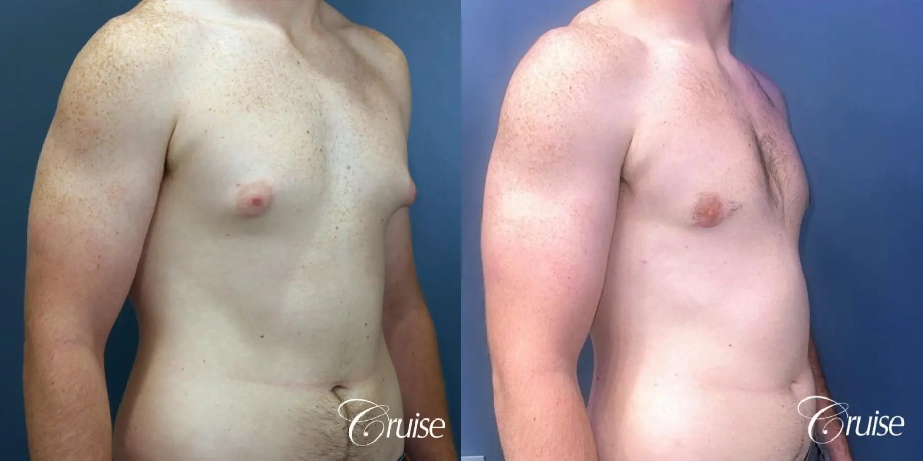 Gynecomastia: Patient 137 - Before and After 4