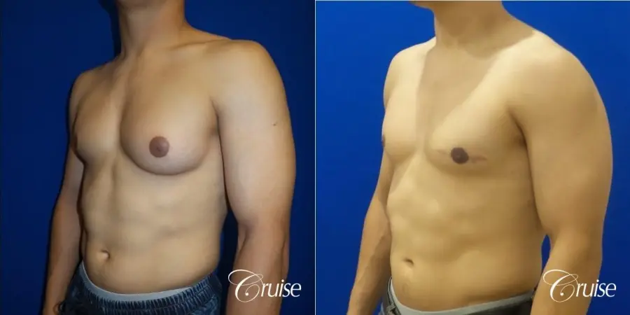 Unilateral gynecomastia before and after - Before and After 2