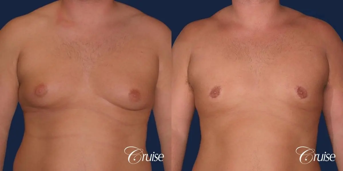 donut lift Gynecomastia correction - Before and After 1