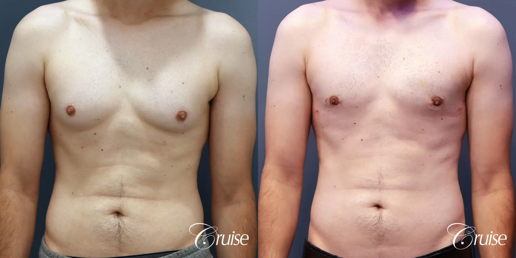 Gynecomastia: Patient 138 - Before and After 1