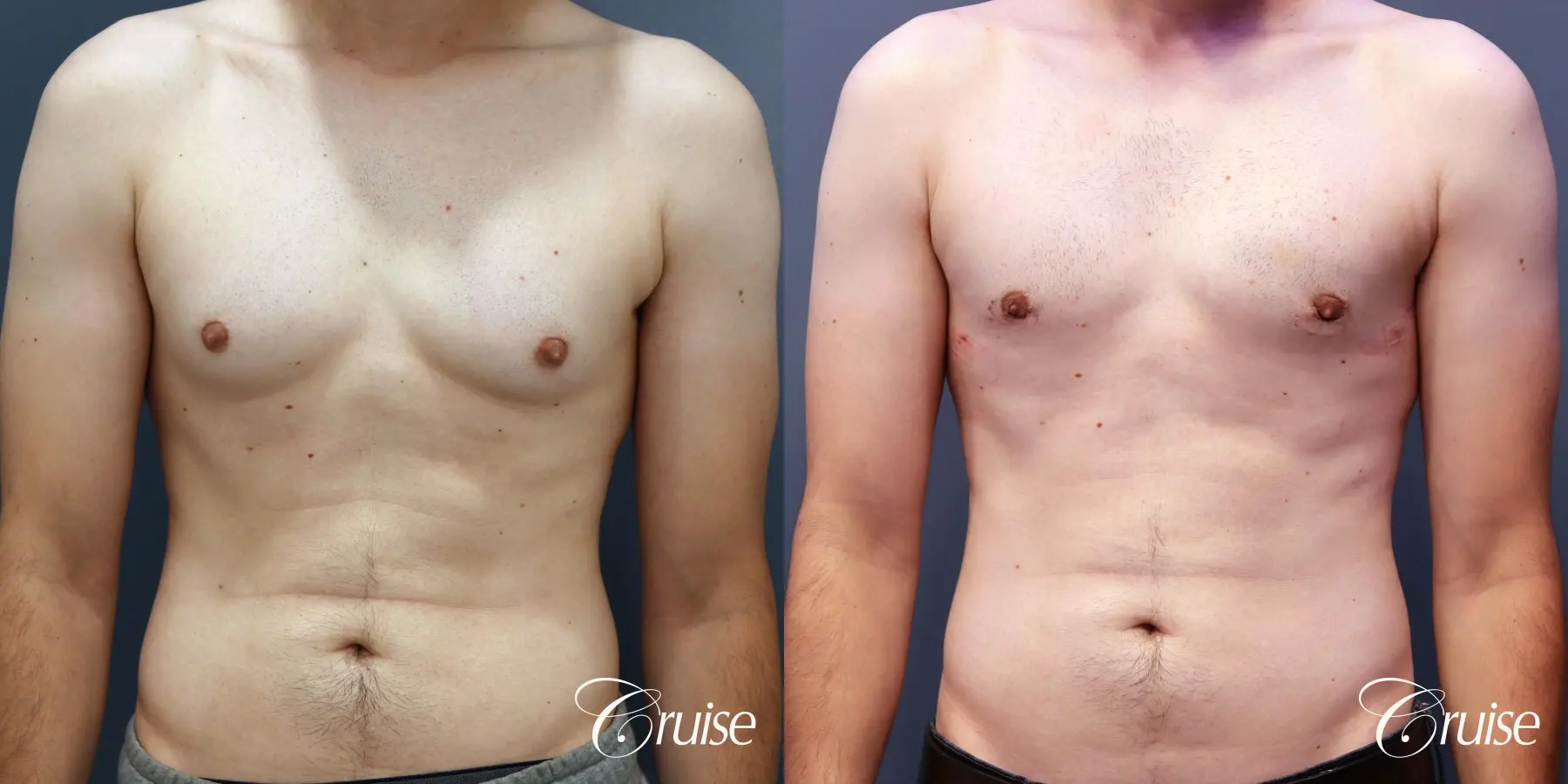 Gynecomastia: Patient 140 - Before and After 1