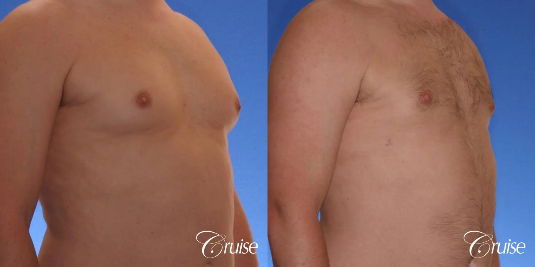 male adult with gynecomastia - Before and After 3