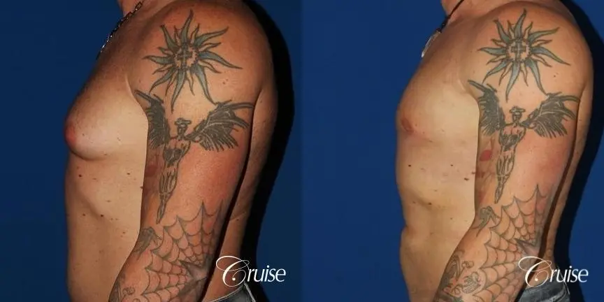 Athletic adult gynecomastia with glandular tissue removal - Before and After 3