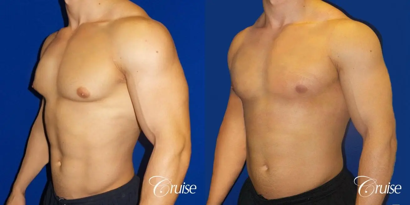 Type 1 Body Builder Puffy Nipple Correction - Before and After 2