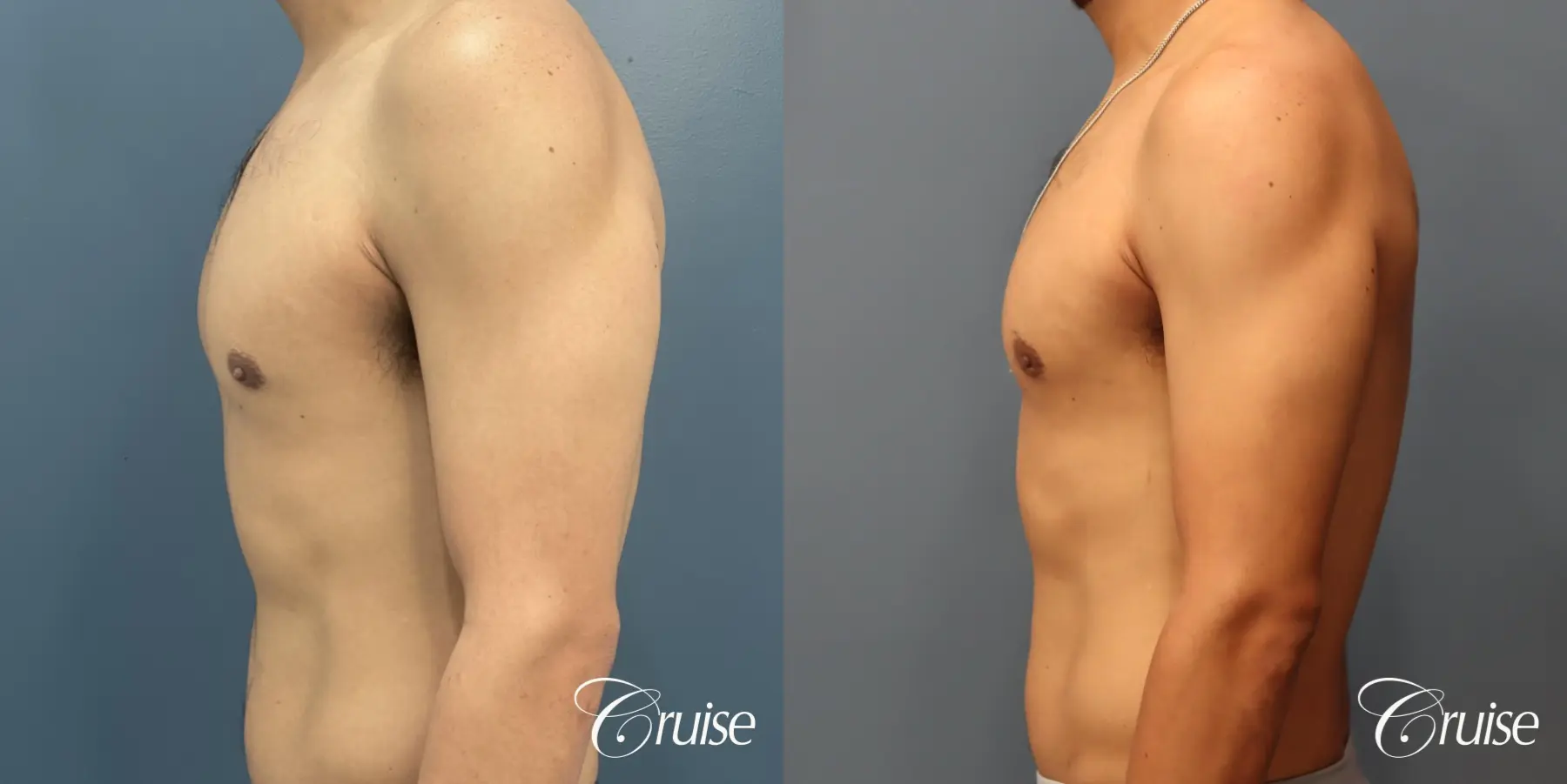 Gynecomastia: Patient 139 - Before and After 5