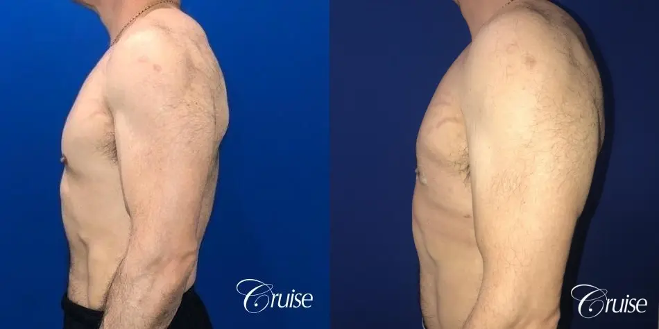 Gynecomastia: Patient 140 - Before and After 3