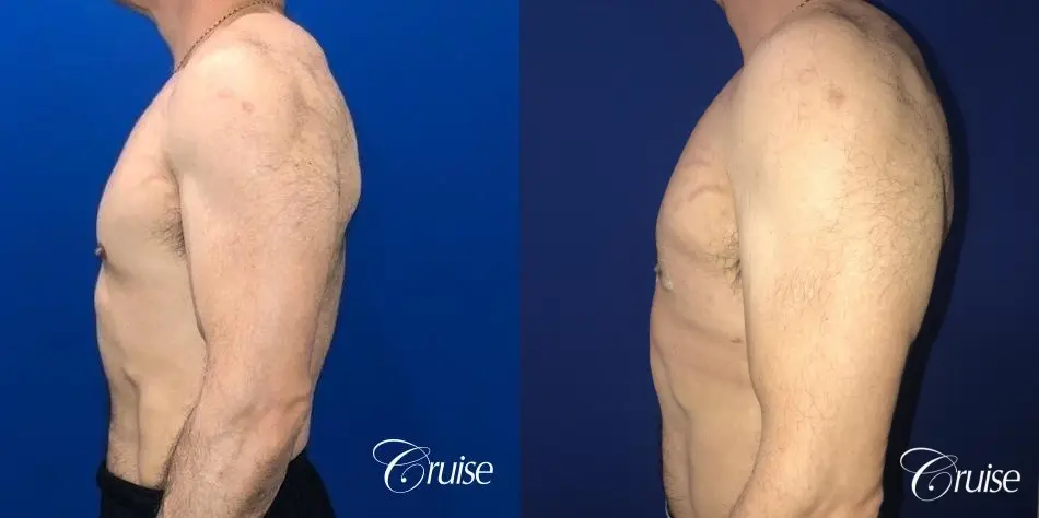 Gynecomastia: Patient 142 - Before and After 3