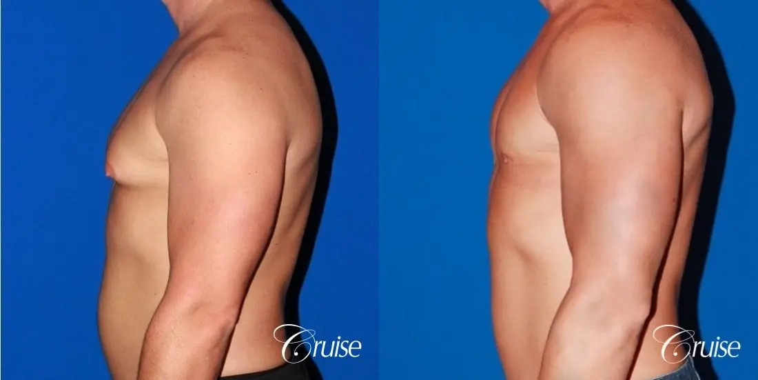 body builder with Gynecomastia puffy nipple - Before and After 2