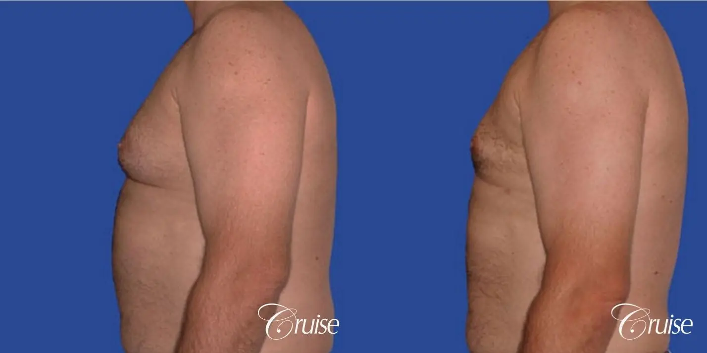 chest liposuction on adult - Before and After 2