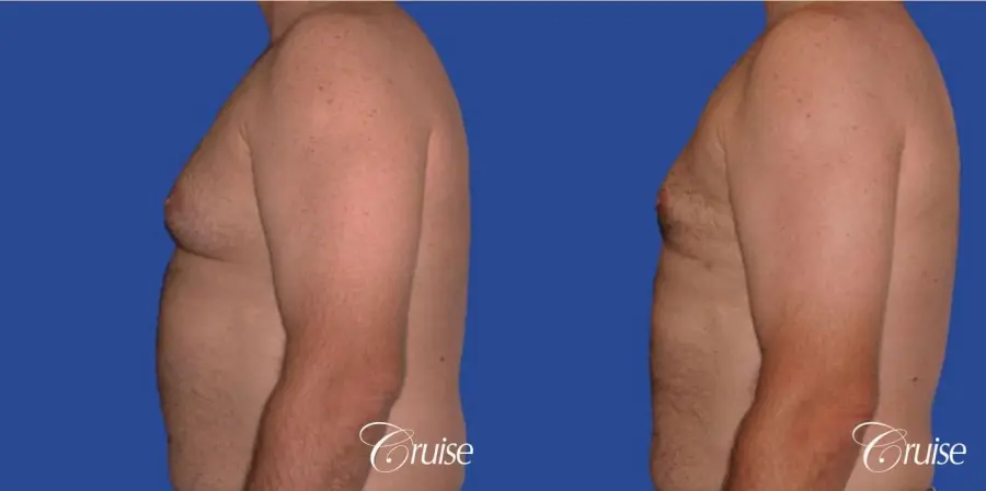 chest liposuction on adult - Before and After 2