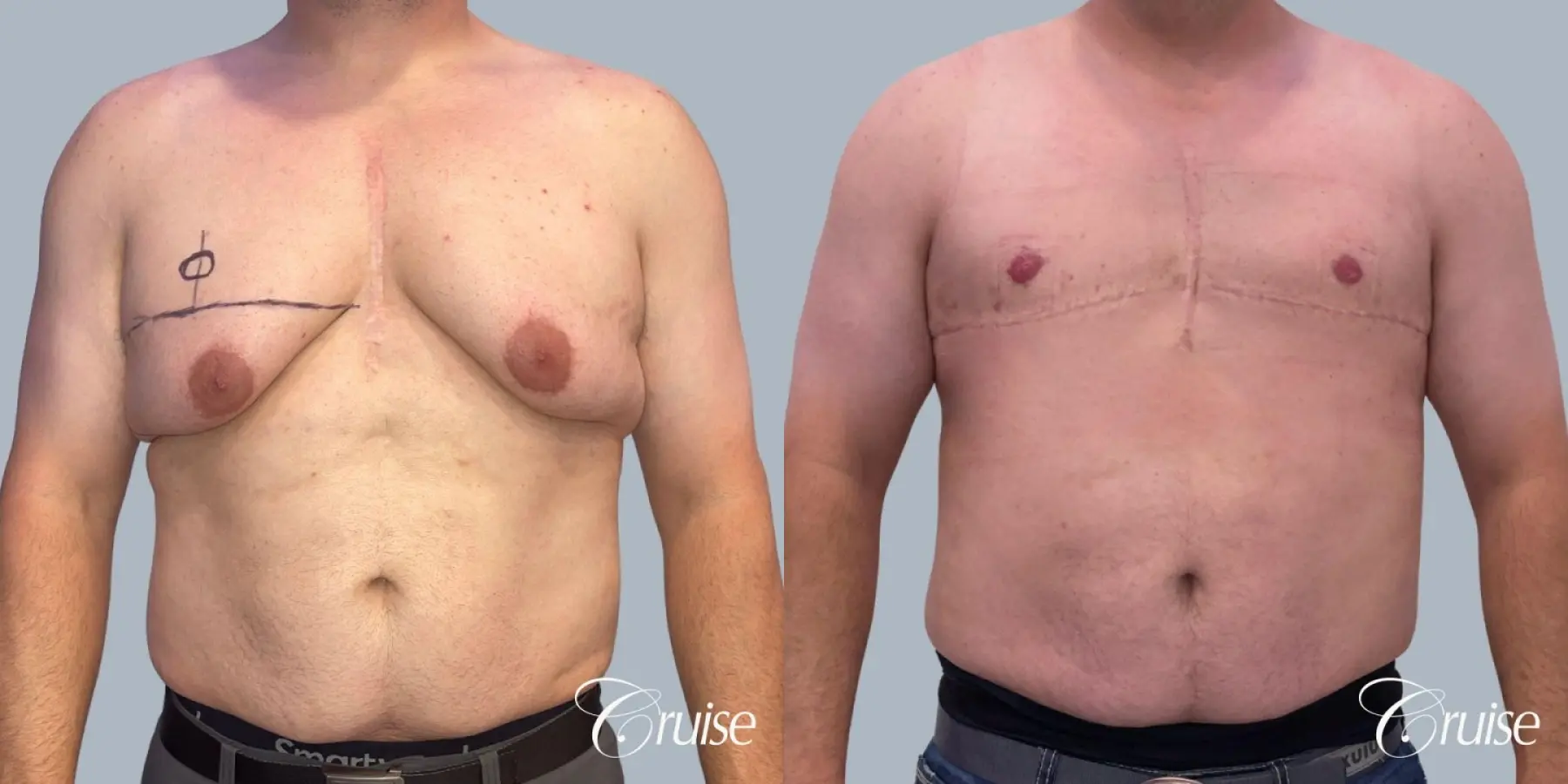 Gynecomastia: Patient 3 - Before and After 1