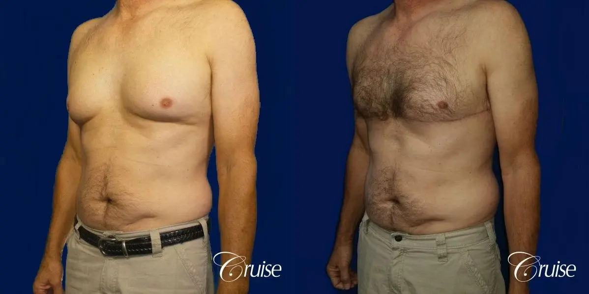 Type 4 Gynecomastia Gland Removal & Liposuction  - Before and After 3