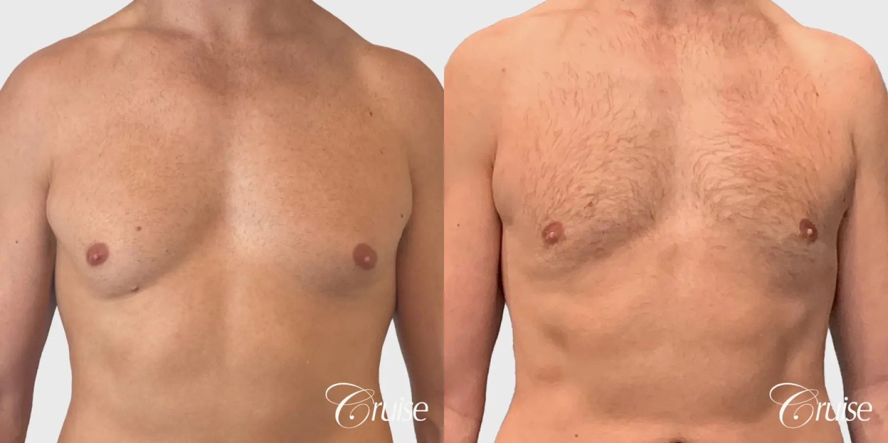 Gynecomastia Removal - Before and After 1