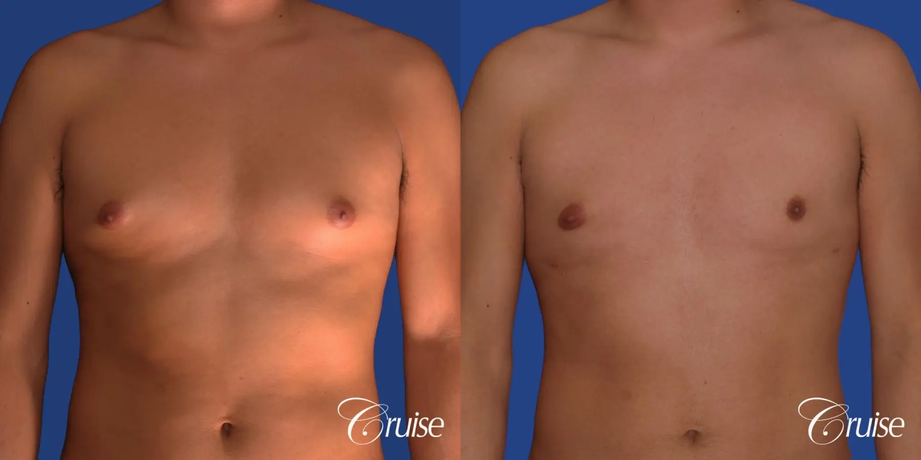 best gynecomastia results with gynecomastia plastic surgeon - Before and After 1