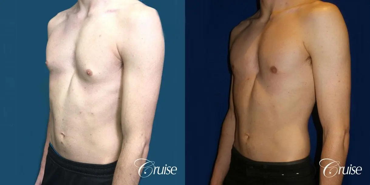 Top Gynecomastia Specialist Dr. Cruise - Before and After 3