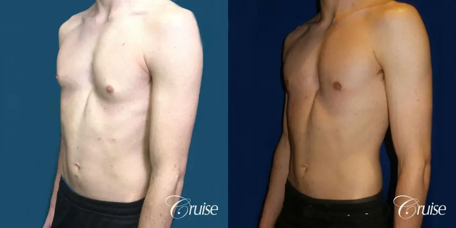 Top Gynecomastia Specialist Dr. Cruise - Before and After 3