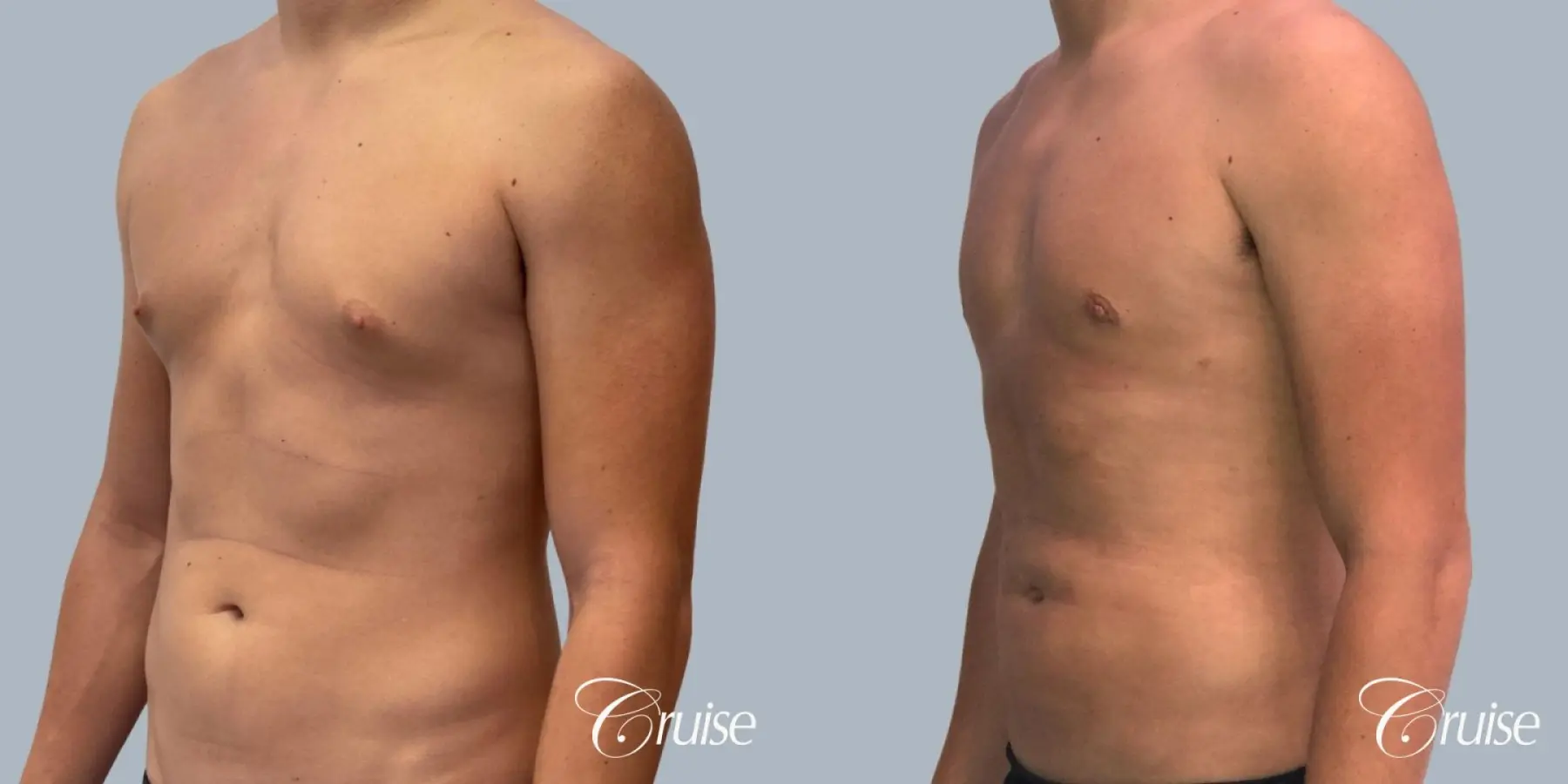 Gynecomastia: Patient 18 - Before and After 3