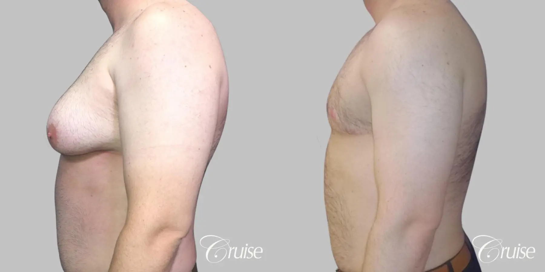 Severe Gynecomastia- Free nipple Graft - Before and After 3