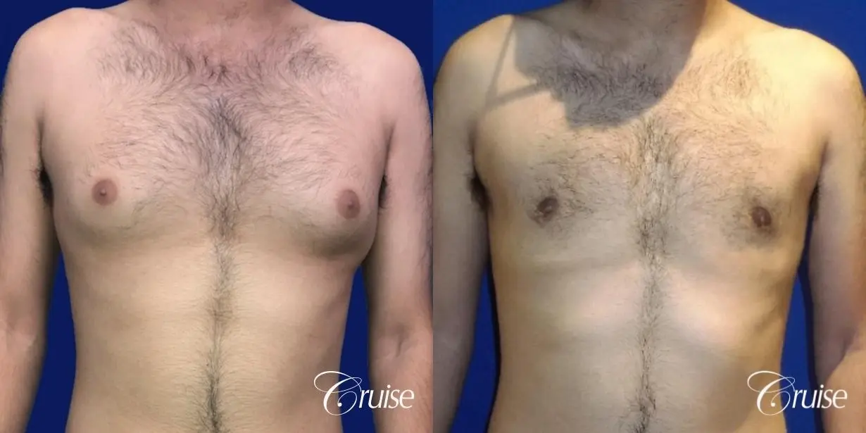 Moderate Gynecomastia Areola Incision - Before and After 1