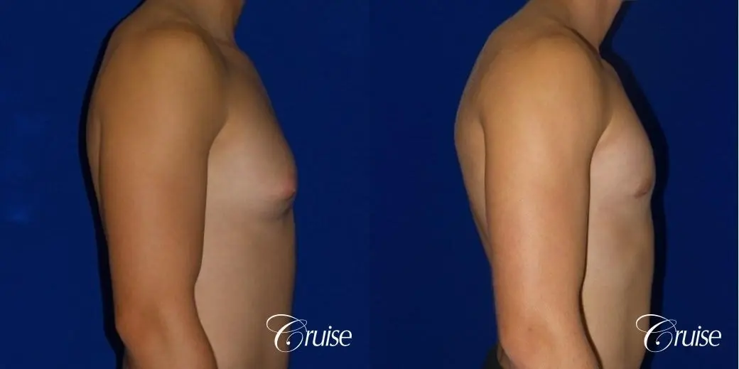 teenage gynecomastia before and afters - Before and After 3