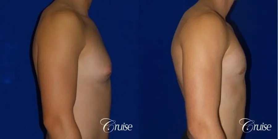 teenage gynecomastia before and afters - Before and After 3