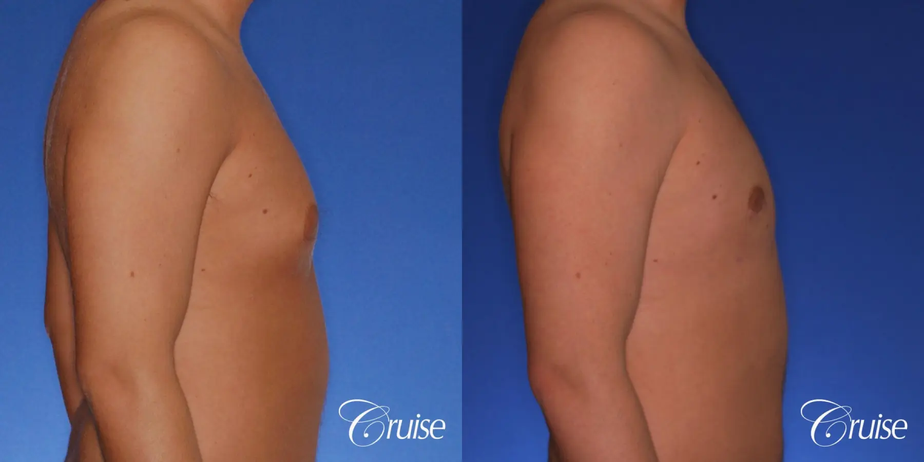 best puffy nipple gynecomastia results with plastic surgeon, Joseph Cruise, M.D. - Before and After 3