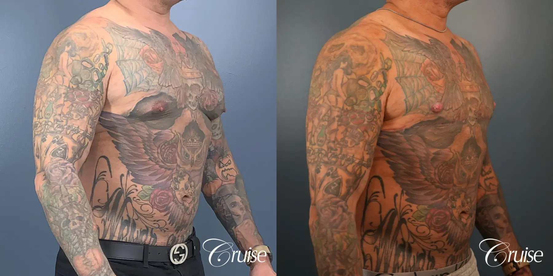 Gynecomastia: Patient 143 - Before and After 5