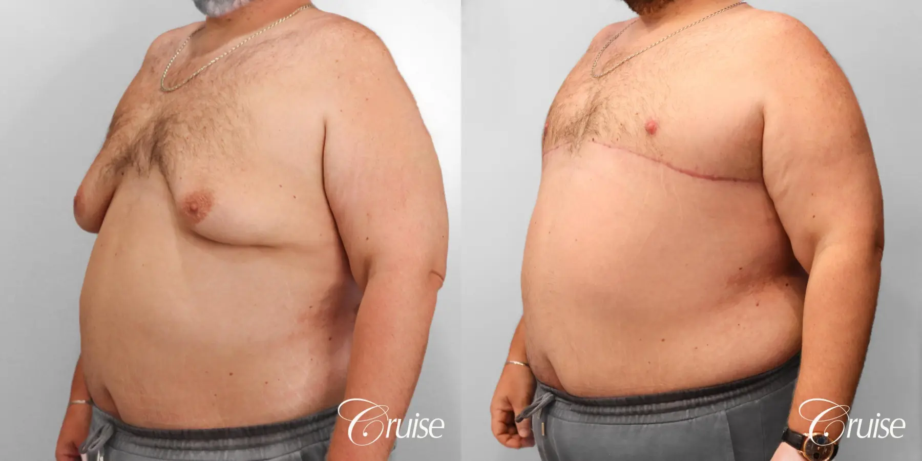 Gynecomastia: Patient 145 - Before and After 2