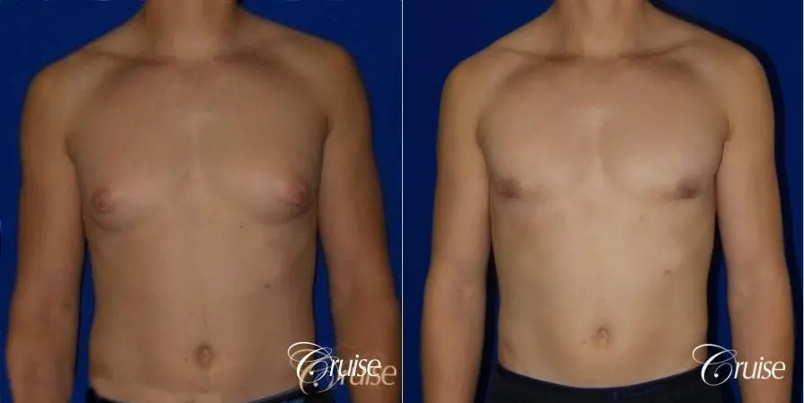 teenage gynecomastia before and afters - Before and After 1