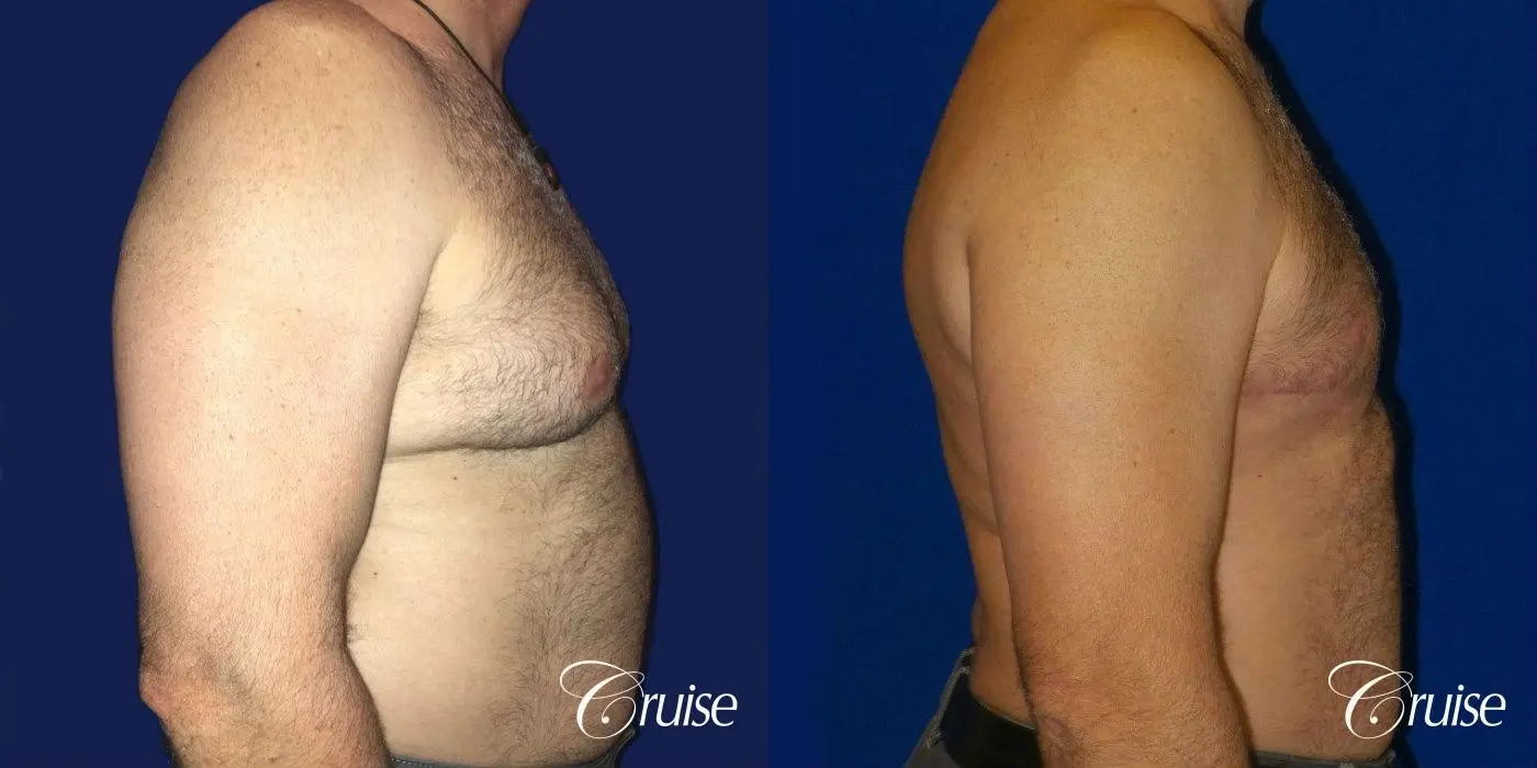Severe Gynecomastia Correction - Before and After 3