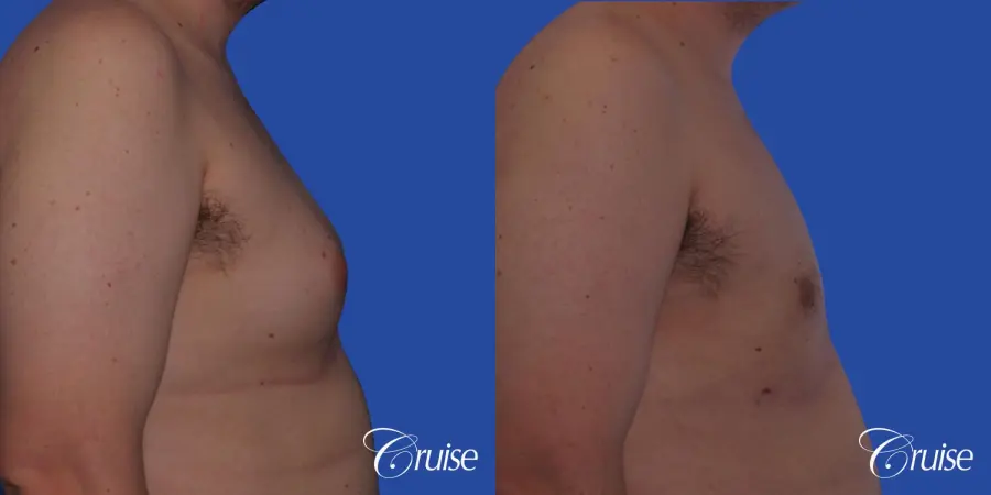 Type 2 Gynecomastia with Excess Breast Tissue - Before and After 3