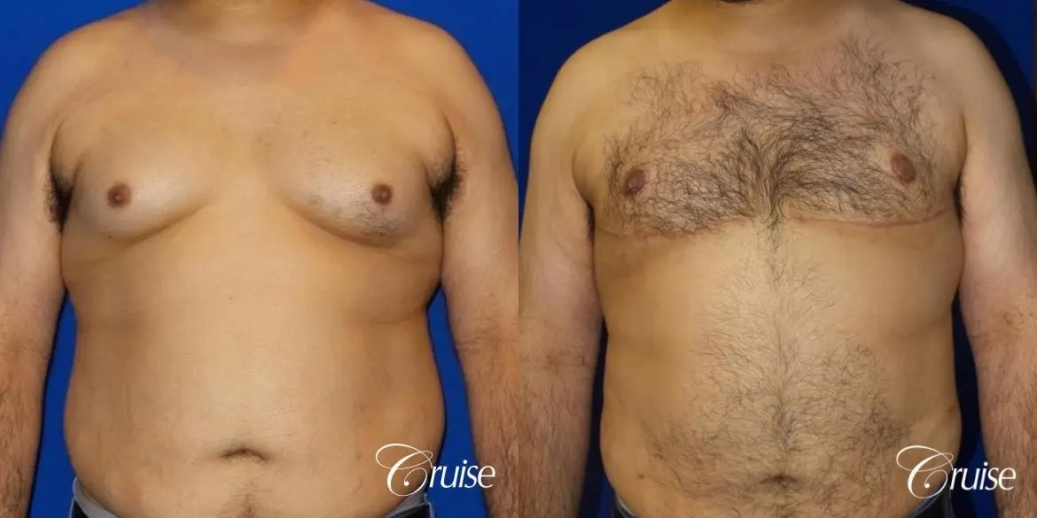 Type 4.5 Gynecomastia Free Nipple Graft - Before and After 1