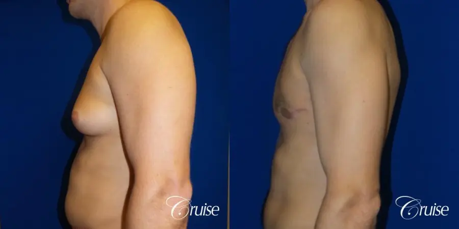 Unilateral gynecomastia - Before and After 3