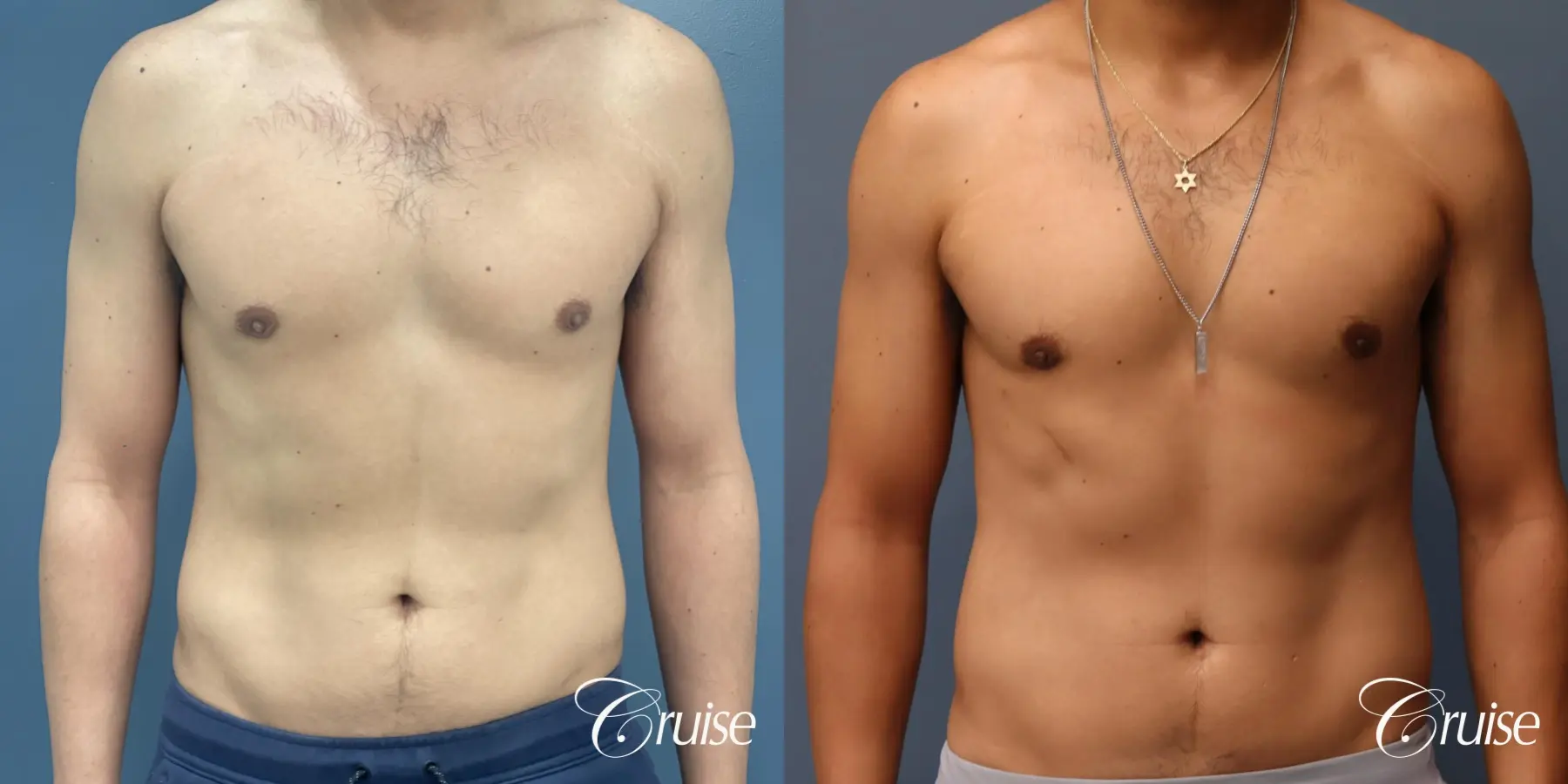 Gynecomastia: Patient 139 - Before and After 1