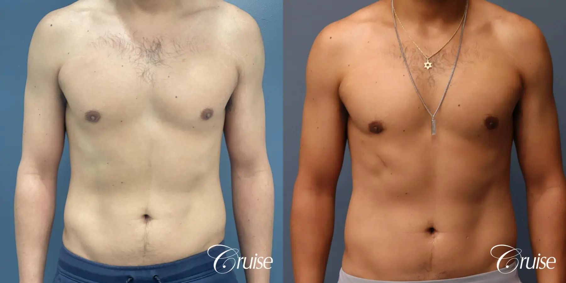 Gynecomastia: Patient 141 - Before and After 1