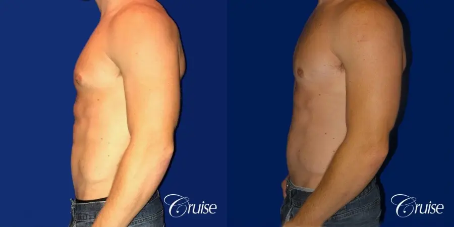 body builder puffy nipple gynecomastia - Before and After 2