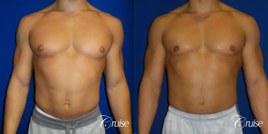 bodybuilder with gynecomastia - Before and After 1