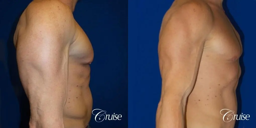 Body builder gynecomastia before and after pictures - Before and After 2