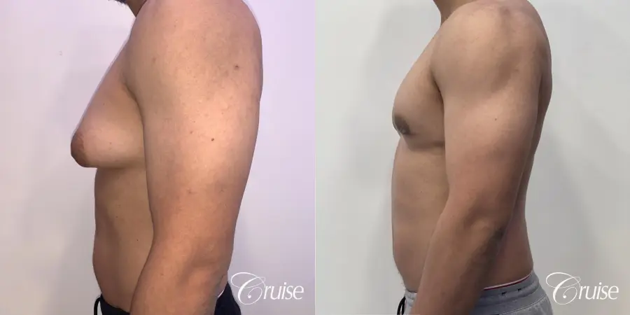 gynecomastia surgery - Before and After 2