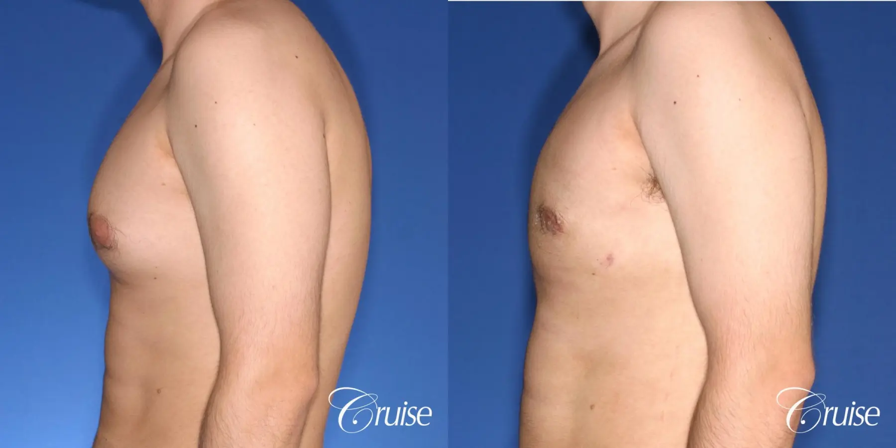 moderate gynecomastia puffy nipple - Before and After 2