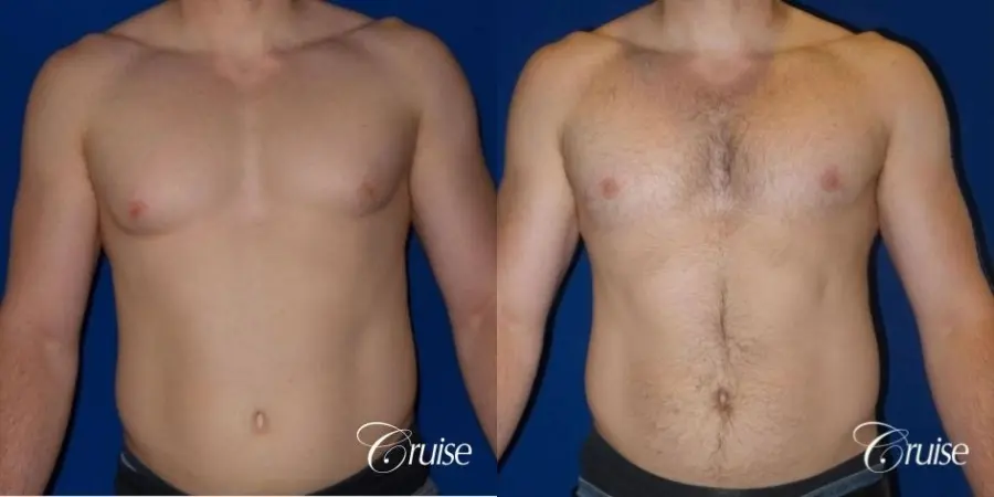 Dr. Cruise gynecomastia surgery photos - Before and After 1