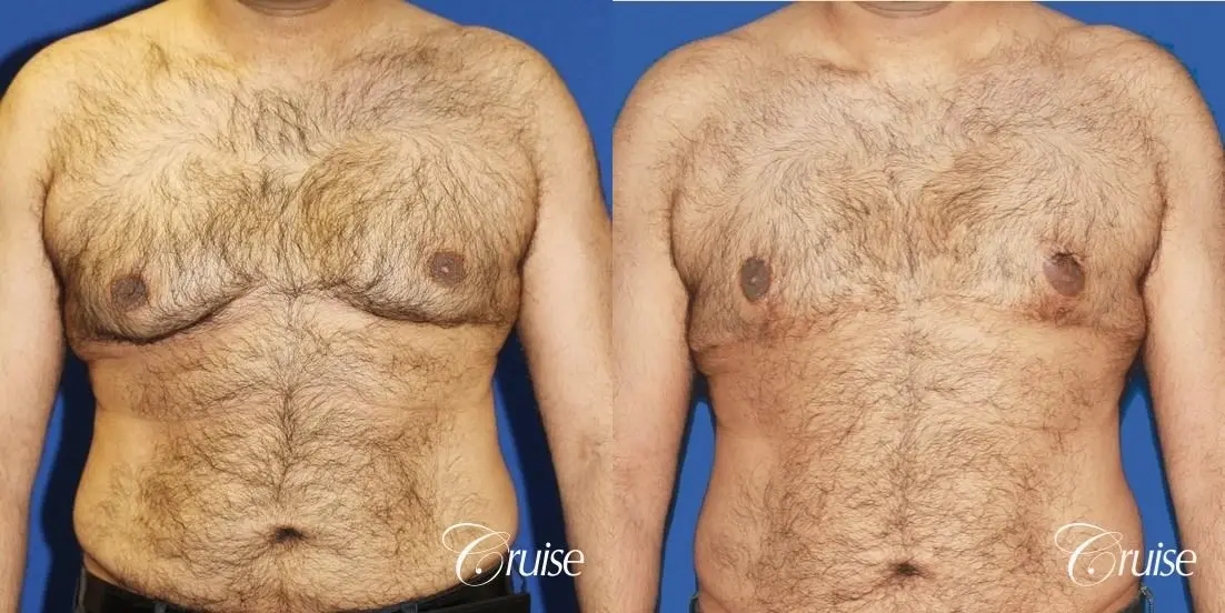 40 year old with severe gynecomastia results - Before and After 1