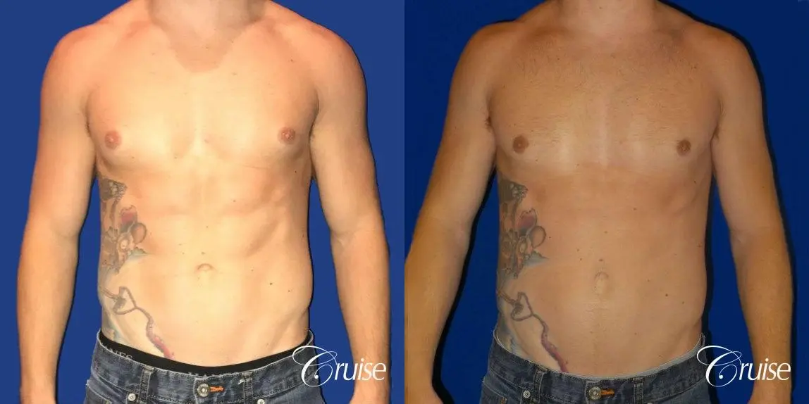 body builder puffy nipple gynecomastia - Before and After 1