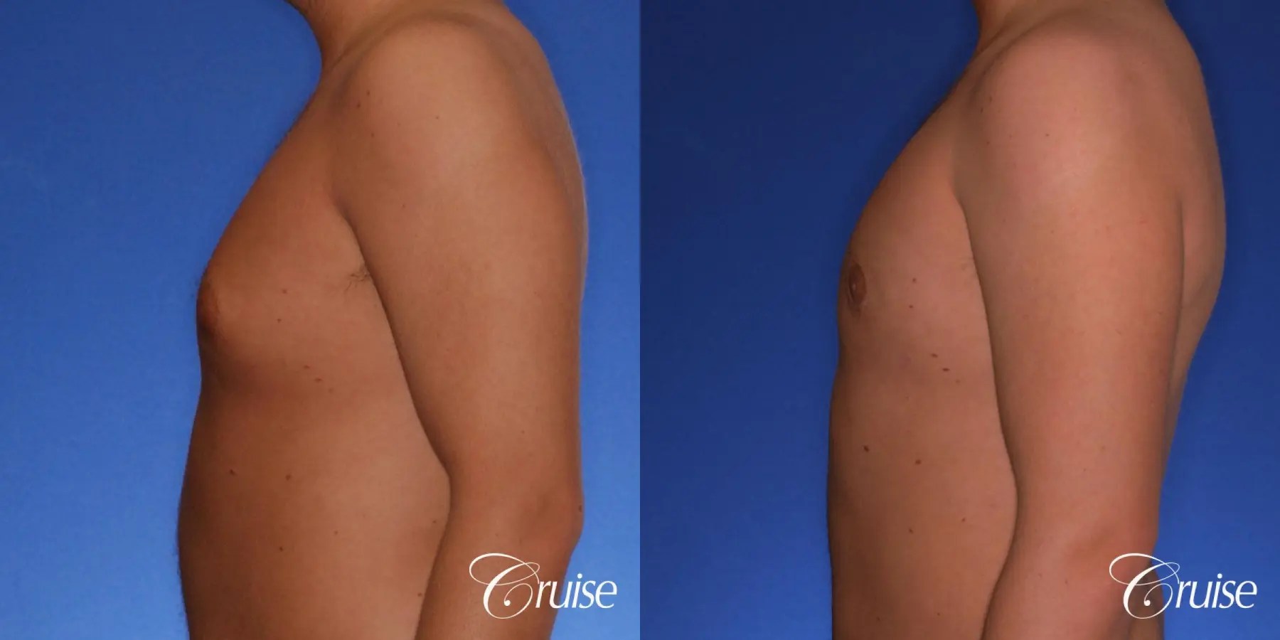 best puffy nipple gynecomastia results with plastic surgeon, Joseph Cruise, M.D. - Before and After 2