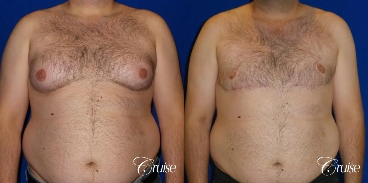 severe gynecomastia surgery - Before and After 1