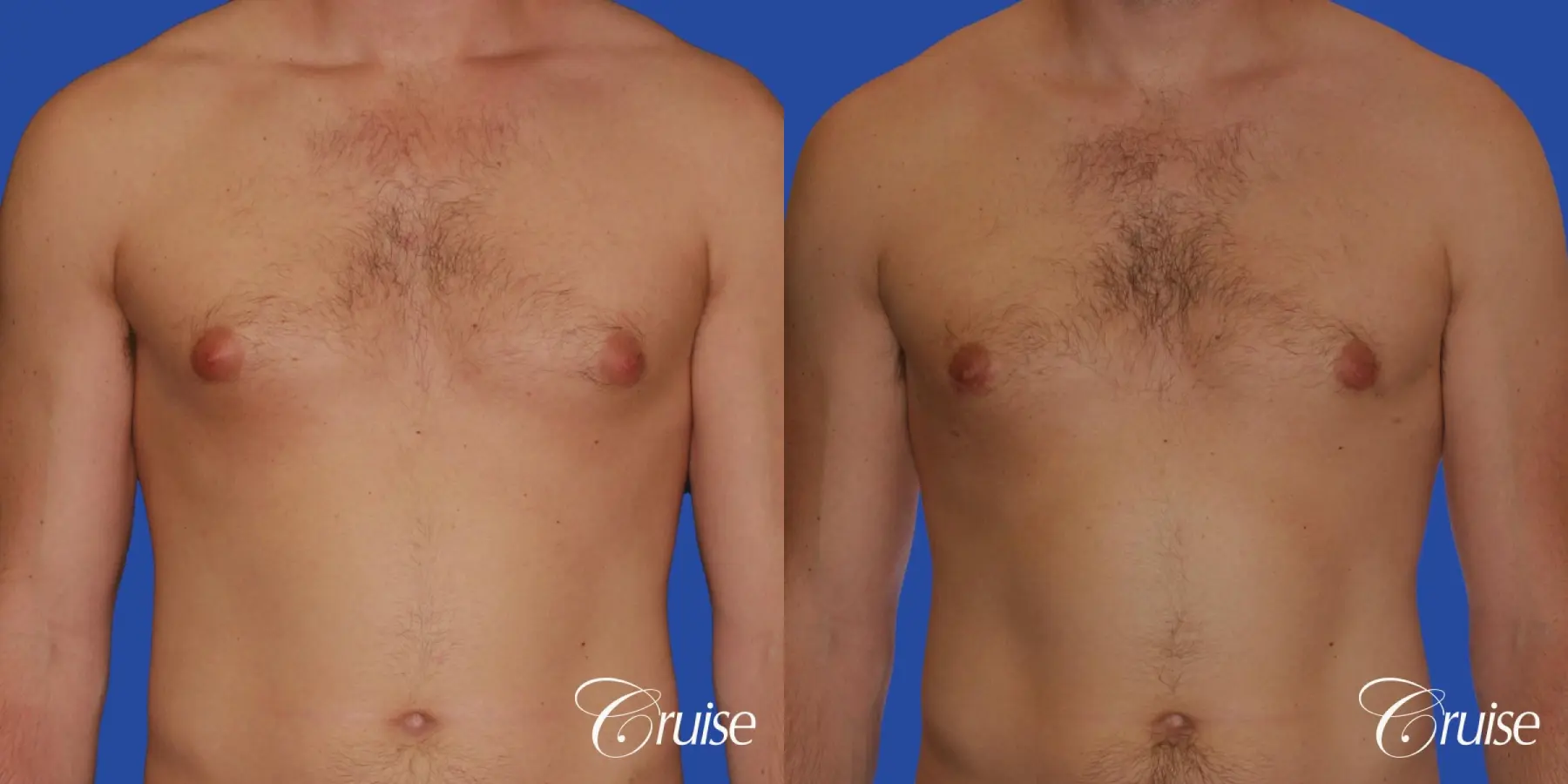 young adult with puffy nipple gets the best results with top gynecomastia surgeon - Before and After 1